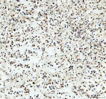 IHC testing of FFPE human gastric cancer tissue with PER1 antibody at 1ug/ml. Required HIER: steam section in pH8 EDTA buffer for 20 min and allow to cool prior to testing.