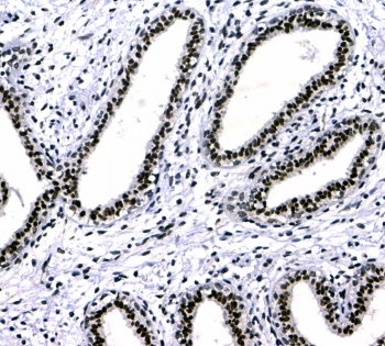 IHC testing of FFPE human breast cancer tissue with CBX3 antibody at 1ug/ml. Required HIER: steam section in pH6 citrate buffer for 20 min and allow to cool prior to testing.