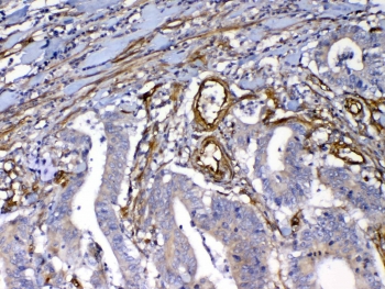 IHC testing of FFPE human rectal cancer tissue with VEGF Receptor 3 antibody at 1ug/ml. Required HIER: steam section in pH6 citrate buffer for 20 min and allow to cool prior to testing.