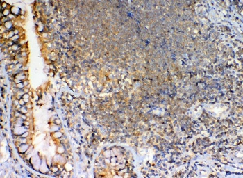 IHC staining of FFPE human lung cancer with GRK2 antibody. HIER: boil tissue sections in pH6, 10mM citrate buffer, for 20 min and allow to cool before testing.