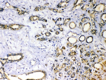 IHC testing of FFPE human breast cancer tissue with SOD3 antibody at 1ug/ml. Required HIER: steam section in pH6 citrate buffer for 20 min and allow to cool prior to testing.
