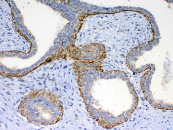 IHC testing of FFPE human breast cancer tissue with FZD4 antibody at 1ug/ml. Required HIER: steam section in pH6 citrate buffer for 20 min and allow to cool prior to testing.