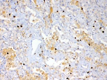 IHC testing of FFPE human lung cancer tissue with Psoriasin antibody at 1ug/ml. Required HIER: steam section in pH6 citrate buffer for 20 min and allow to cool prior to testing.