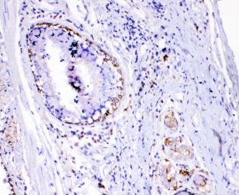 TL1A Antibody Lung Cancer Immunohistochemistry. IHC testing of FFPE human lung cancer with TL1A antibody. HIER: boil tissue sections in pH6, 10mM citrate buffer, for 10-20 min followed by cooling at RT for 20 min.