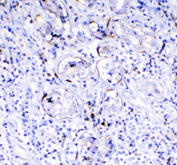 TL1A Antibody Lung Cancer IHC. Immunohistochemistry staining of FFPE human lung cancer with TL1A antibody. HIER: boil tissue sections in pH6, 10mM citrate buffer, for 10-20 min followed by cooling at RT for 20 min.