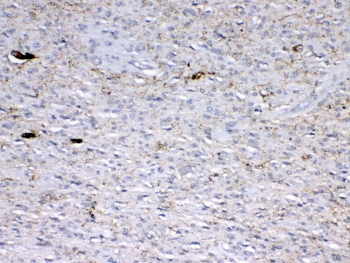 GAD65 Antibody Glioma IHC. Immunohistochemistry testing of FFPE human glioma with polyclonal GAD65 antibody at 1ug/ml. Required HIER: steam section in pH6 citrate buffer for 20 min and allow to cool prior to testing.