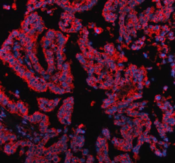 Immunofluorescent staining of FFPE human lung cancer tissue with PDK2 antibody (red) and DAPI nuclear stain (blue). HIER: steam section in pH8 EDTA buffer for 20 min.