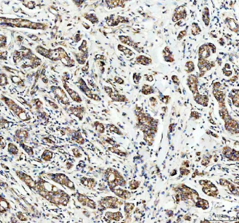 IHC staining of FFPE human breast cancer tissue with PDK2 antibody, HRP-secondary and DAB substrate. HIER: boil tissue sections in pH8 EDTA for 20 min and allow to cool before testing.