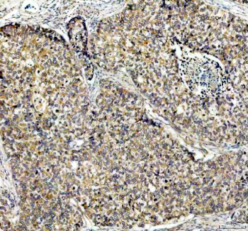 IHC staining of FFPE human lung cancer tissue with PDK2 antibody, HRP-secondary and DAB substrate. HIER: boil tissue sections in pH8 EDTA for 20 min and allow to cool before testing.
