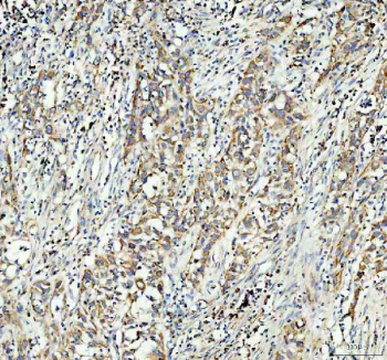 Immunohistochemical staining of FFPE human bladder cancer tissue using GSTM3 antibody. Staining is observed predominantly in tumor epithelial cells, with cytoplasmic localization. Visualization was performed using an HRP-conjugated secondary antibody and DAB substrate, with hematoxylin counterstaining. Heat-induced epitope retrieval was performed using EDTA buffer (pH 8.0).