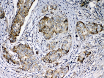 FZD3 Antibody Breast Cancer IHC. Immunohistochemical staining of FFPE human breast cancer tissue using FZD3 Antibody demonstrates moderate to strong membranous and cytoplasmic staining within malignant epithelial cells. FZD3 is a Wnt signaling receptor that regulates cell polarity, developmental signaling, and tissue morphogenesis, and has been implicated in pathways associated with tumor progression and cellular migration. The observed staining pattern is consistent with FZD3 expression in breast carcinoma cells and supports the utility of this antibody for immunohistochemical detection of Frizzled 3 in FFPE tissues. HIER: steam section in pH6 citrate buffer for 20 minutes and allow to cool prior to testing.