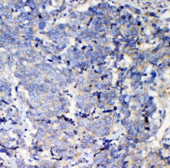 IHC staining of FFPE human lung cancer with IQGAP2 antibody. HIER: boil tissue sections in pH8 EDTA for 20 min and allow to cool before testing.