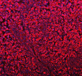 Immunofluorescent staining of FFPE human testis cancer tissue with DYNLT1 antibody (red) and DAPI nuclear stain (blue). HIER: steam section in pH8 EDTA buffer for 20 min.