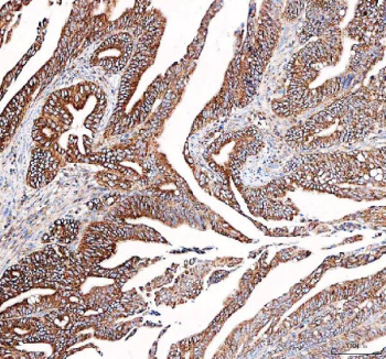 Immunohistochemical staining of FFPE human colon adenocarcinoma tissue with DYNLT1 antibody, HRP-secondary and DAB substrate. HIER: boil tissue sections in pH8 EDTA for 20 min and allow to cool before testing.