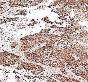 Immunohistochemical staining of FFPE human esophageal keratinizing squamous cell carcinoma tissue with DYNLT1 antibody, HRP-secondary and DAB substrate. HIER: boil tissue sections in pH8 EDTA for 20 min and allow to cool before testing.