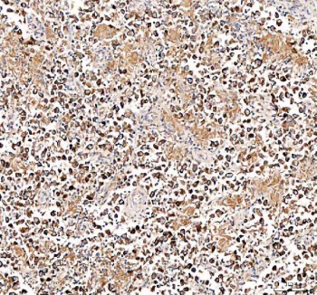 Immunohistochemical staining of FFPE human testis cancer tissue with DYNLT1 antibody, HRP-secondary and DAB substrate. HIER: boil tissue sections in pH8 EDTA for 20 min and allow to cool before testing.