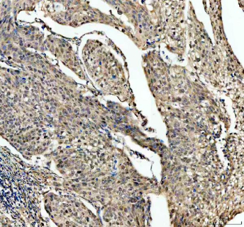 IHC staining of FFPE human cervical cancer tissue with SKP2 antibody, HRP-labeled secondary and DAB substrate. HIER: boil tissue sections in pH8 EDTA for 20 min and allow to cool before testing.