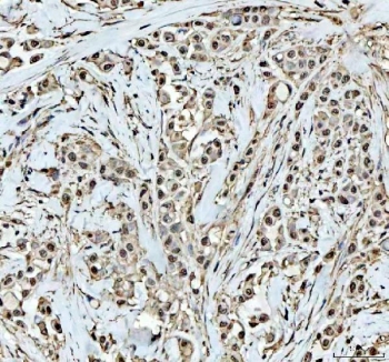 IHC staining of FFPE human breast cancer tissue with DCK antibody. HIER: boil tissue sections in pH8 EDTA for 20 min and allow to cool before testing.