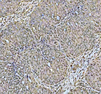 IHC staining of FFPE human ovarian cancer tissue with DCK antibody. HIER: boil tissue sections in pH8 EDTA for 20 min and allow to cool before testing.