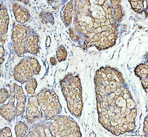 P2RY5 Antibody Human Ovarian Teratoma IHC. Immunohistochemical analysis of FFPE human ovarian teratoma tissue using P2RY5 Antibody. Heat-induced epitope retrieval was performed in pH 8.0 EDTA buffer prior to incubation with the primary antibody at 2 ug/mL overnight at 4Â°C. An HRP-conjugated goat anti-rabbit secondary antibody with DAB chromogen was used for visualization. Distinct membranous and cytoplasmic staining is observed in epithelial cells within the teratoma, consistent with LPAR6/P2RY5 expression. These results demonstrate that P2RY5 Antibody, a Lysophosphatidic Acid Receptor Antibody, specifically detects endogenous receptor expression in FFPE human tissue.