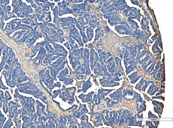 IHC staining of FFPE human ovarian serous adenocarcinoma tissue with Serum Amyloid P antibody. HIER: boil tissue sections in pH8 EDTA for 20 min and allow to cool before testing.
