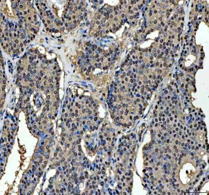 MRE11 Antibody Human Breast Cancer IHC. Immunohistochemical staining of FFPE human breast cancer tissue using MRE11 antibody demonstrated predominantly nuclear staining in tumor cells, consistent with the role of MRE11 as a key component of the MRN complex involved in DNA double-strand break recognition and repair. Heat-induced epitope retrieval was performed in pH 8.0 EDTA buffer prior to staining. Tissue sections were blocked with 10% goat serum and incubated with the primary antibody (2 ug/ml) overnight at 4Â°C, followed by a peroxidase-conjugated goat anti-rabbit IgG secondary antibody. Immunoreactivity was visualized using an HRP Super Vision detection system with DAB as the chromogen. This MRE11 Antibody, also called a DNA Double-Strand Break Repair Protein Antibody, is useful for investigating genome stability, DNA damage response signaling, MRN complex biology, and cancer research.