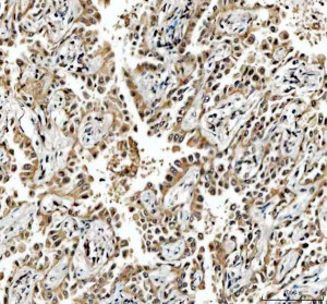 MRE11 Antibody Human Lung Cancer IHC. Immunohistochemical staining of FFPE human lung cancer tissue using MRE11 antibody demonstrated predominantly nuclear staining in malignant cells, consistent with the role of MRE11 in DNA double-strand break recognition, DNA end processing, and genome maintenance as a core component of the MRN complex. Heat-induced epitope retrieval was performed in pH 8.0 EDTA buffer prior to staining. Tissue sections were blocked with 10% goat serum and incubated with the primary antibody (2 ug/ml) overnight at 4Â°C, followed by a peroxidase-conjugated goat anti-rabbit IgG secondary antibody. Immunoreactivity was visualized using an HRP Super Vision detection system with DAB as the chromogen. This MRE11 Antibody, also called a DNA Double-Strand Break Repair Protein Antibody, is useful for investigating DNA damage response signaling, genome stability, MRN complex biology, and lung cancer research.