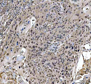 MRE11 Antibody Human Oral Squamous Cell Carcinoma IHC. Immunohistochemical staining of FFPE human oral keratinizing squamous cell carcinoma tissue using MRE11 antibody demonstrated predominantly nuclear staining in malignant epithelial cells, consistent with the localization of MRE11 as a key DNA repair nuclease within the MRN complex. Heat-induced epitope retrieval was performed in pH 8.0 EDTA buffer prior to staining. Tissue sections were blocked with 10% goat serum and incubated with the primary antibody (2 ug/ml) overnight at 4Â°C, followed by a peroxidase-conjugated goat anti-rabbit IgG secondary antibody. Immunoreactivity was visualized using an HRP Super Vision detection system with DAB as the chromogen. This MRE11 Antibody, also called a DNA Double-Strand Break Repair Protein Antibody, is useful for investigating DNA damage response signaling, genome stability, MRN complex biology, and head and neck cancer research.