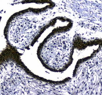 IHC testing of FFPE human breast cancer tissue with STUB1 antibody at 1ug/ml. Required HIER: steam section in pH6 citrate buffer for 20 min and allow to cool prior to staining.