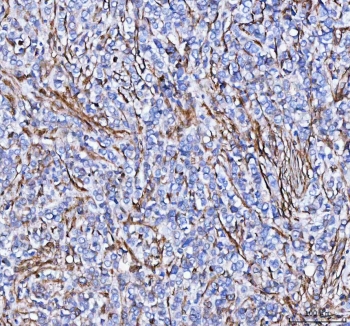IHC staining of FFPE human breast cancer tissue with S100A10 antibody. HIER: boil tissue sections in pH8 EDTA for 20 min and allow to cool before testing.