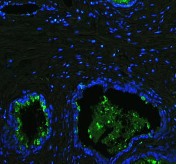 Immunofluorescent staining of human prostate cancer tissue with Lactoferrin antibody (green) and DAPI nuclear stain (blue). HIER: steam section in pH6 citrate buffer for 20 min.