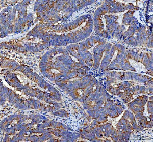 MVP Antibody Human Colon Cancer IHC. Immunohistochemical staining of FFPE human colon cancer tissue using MVP Antibody / Major Vault Protein Antibody at 2 ug/ml. Heat-induced epitope retrieval was performed using pH8 EDTA buffer, followed by HRP-conjugated secondary antibody detection and DAB chromogen. Strong cytoplasmic staining is observed throughout the glandular tumor epithelium, consistent with the expected localization of Major Vault Protein. This MVP Antibody, also called Major Vault Protein Antibody, is suitable for studies of vault ribonucleoprotein complexes, intracellular transport, multidrug resistance, and Major Vault Protein expression.