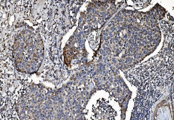 IHC testing of FFPE human breast cancer tissue with CLPP antibody. HIER: boil tissue sections in pH8 EDTA for 20 min and allow to cool before testing.