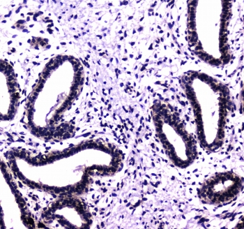 IHC testing of FFPE human breast cancer tissue with USP7 antibody at 1ug/ml. Required HIER: steam section in pH6 citrate buffer for 20 min and allow to cool prior to staining.