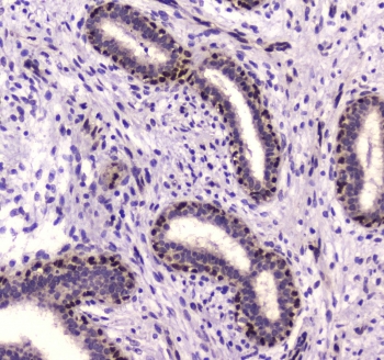 IHC testing of FFPE human breast cancer tissue with NFIB antibody at 1ug/ml. Required HIER: steam section in pH6 citrate buffer for 20 min and allow to cool prior to staining.