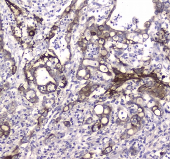 IHC testing of FFPE human colon cancer tissue with LC3A antibody at 1ug/ml. Required HIER: steam section in pH6 citrate buffer for 20 min and allow to cool prior to staining.