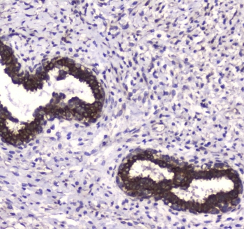 IHC testing of FFPE human breast cancer tissue with LC3A antibody at 1ug/ml. Required HIER: steam section in pH6 citrate buffer for 20 min and allow to cool prior to staining.