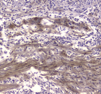 CKB Antibody Colon Cancer IHC. Immunohistochemistry testing of FFPE human colon cancer tissue with CKB antibody at 1ug/ml. Required HIER: steam section in pH6 citrate buffer for 20 min and allow to cool prior to staining.