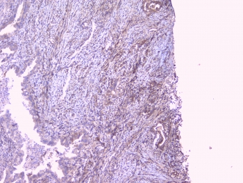 IHC testing of FFPE human intestinal cancer with RKIP antibody at 1ug/ml. HIER: boil tissue sections in pH6, 10mM citrate buffer, for 10-20 min followed by cooling at RT for 20 min.