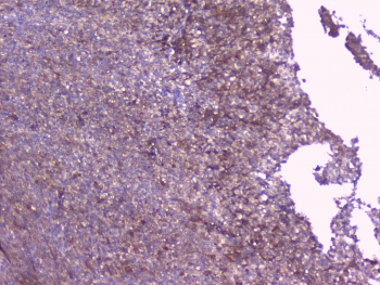 IHC testing of FFPE human sarcoma with RKIP antibody at 1ug/ml. HIER: boil tissue sections in pH6, 10mM citrate buffer, for 10-20 min followed by cooling at RT for 20 min.