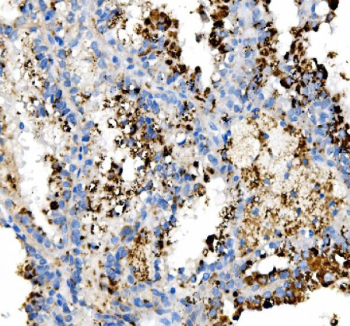IHC testing of FFPE human renal cancer tissue with NPC2 antibody at 2ug/ml. Required HIER: steam section in pH6 citrate buffer for 20 min and allow to cool prior to staining.