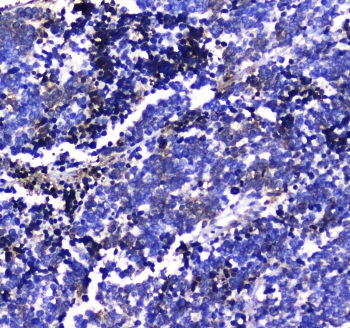IHC testing of FFPE human lung cancer tissue with LGALS3BP antibody at 1ug/ml. Required HIER: steam section in pH6 citrate buffer for 20 min and allow to cool prior to staining.