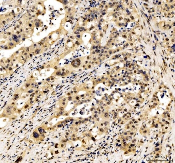 IHC staining of FFPE human appendix adenocarcinoma tissue with JUND antibody. HIER: boil tissue sections in pH8 EDTA for 20 min and allow to cool before testing.