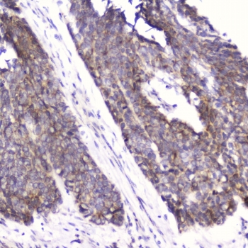 FABP3 Antibody Esophageal Squamous Cell Carcinoma IHC. Immunohistochemistry testing of FFPE human esophageal squamous cell carcinoma with FABP3 antibody at 2ug/ml. HIER: boil tissue sections in pH6, 10mM citrate buffer, for 10-20 min followed by cooling at RT for 20 min.