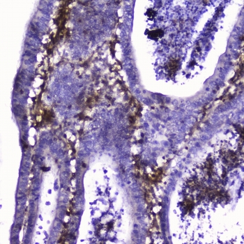 IHC testing of FFPE human intestinal cancer with Talin 1 antibody at 2ug/ml. HIER: boil tissue sections in pH6, 10mM citrate buffer, for 10-20 min followed by cooling at RT for 20 min.