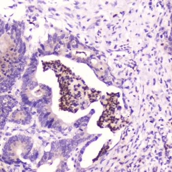 IHC testing of FFPE human colon cancer with SPARCL1 antibody at 2ug/ml. HIER: boil tissue sections in pH6, 10mM citrate buffer, for 10-20 min followed by cooling at RT for 20 min.