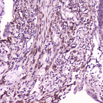 IHC testing of FFPE human intestinal cancer with IL36A antibody at 2ug/ml. HIER: boil tissue sections in pH6, 10mM citrate buffer, for 10-20 min followed by cooling at RT for 20 min.