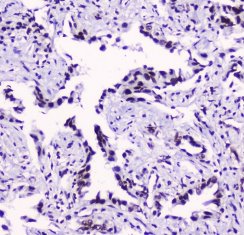 IHC testing of FFPE human lung cancer with SMC3 antibody at 2ug/ml. HIER: boil tissue sections in pH6, 10mM citrate buffer, for 10-20 min followed by cooling at RT for 20 min.