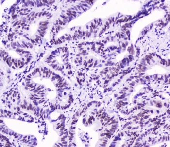 IHC testing of FFPE human intestinal cancer with SMC3 antibody at 2ug/ml. HIER: boil tissue sections in pH6, 10mM citrate buffer, for 10-20 min followed by cooling at RT for 20 min.