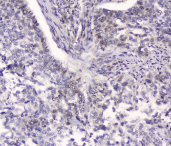 IHC testing of FFPE human lung cancer with HSPA2 antibody at 2ug/ml. HIER: boil tissue sections in pH6, 10mM citrate buffer, for 10-20 min followed by cooling at RT for 20 min.
